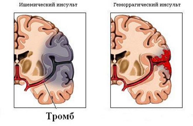 Инсульт мозга